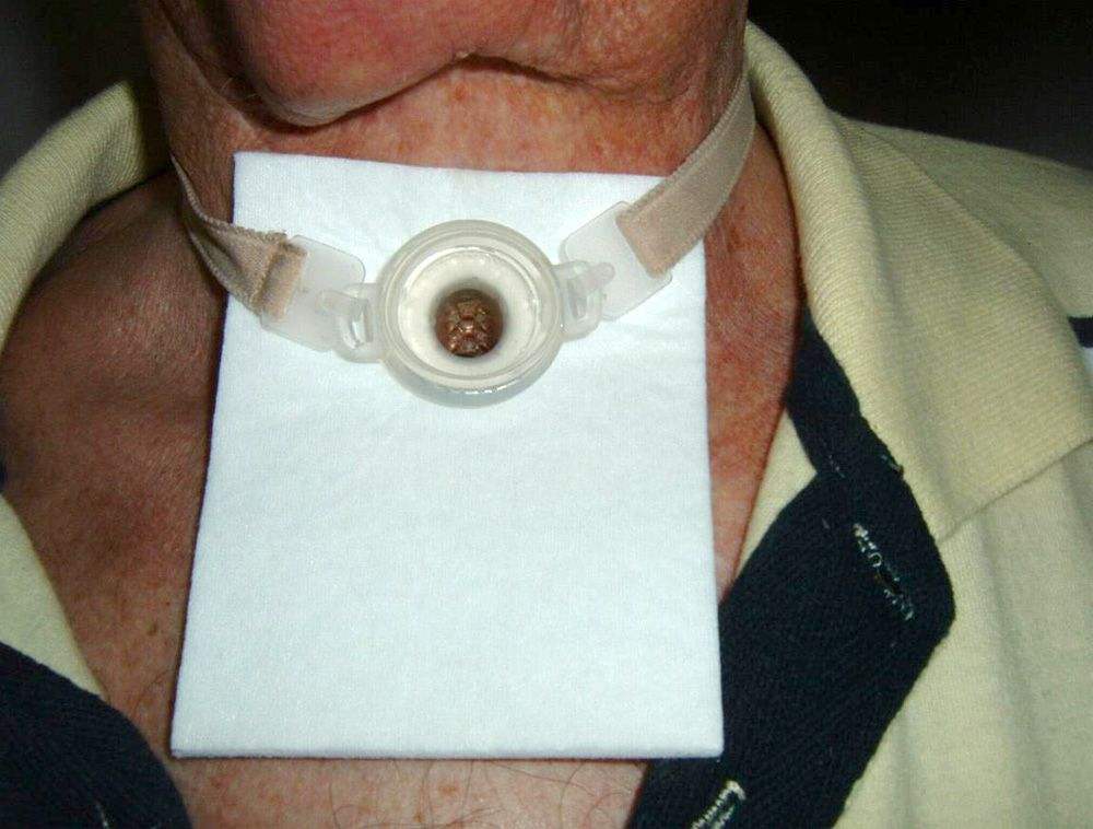Foto: Bild vom Hals eines Menschen mit einem Tracheostoma nach einem Luftröhrenschnitt